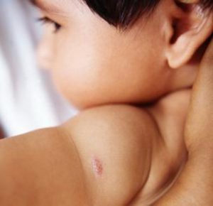 bcg vaccination scar